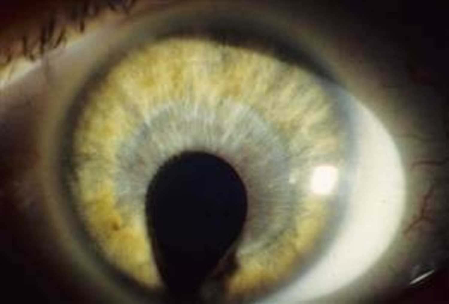 Management Strategies for Vision Problems in Cat Eye Syndrome