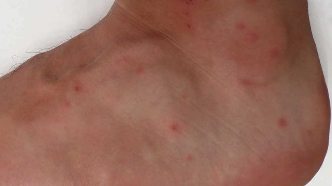 Symptoms of Infestation in Felines