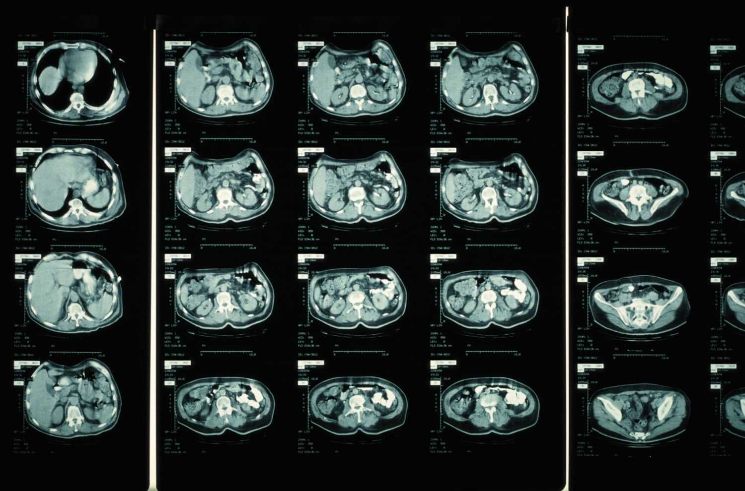 How to Obtain Your Cat Scan Results